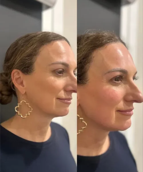 Cheek and Jawline balancing with Radiesse + Filler