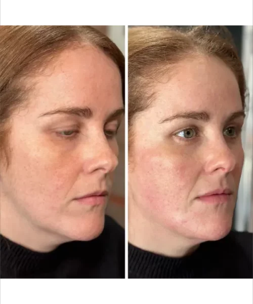 Jawline Balancing with Radiesse + Filler Balancing with Radiesse + Filler