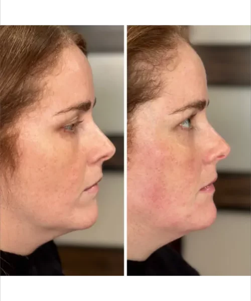 Chin Balancing with Radiesse + Filler