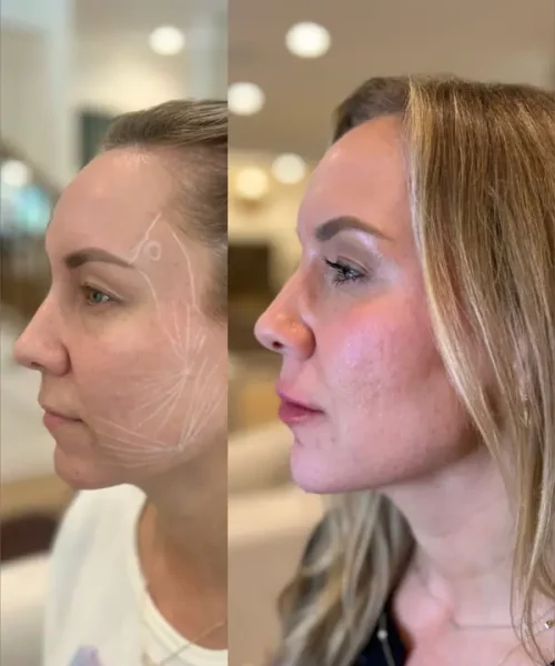 Chin Balancing with Radiesse + Filler