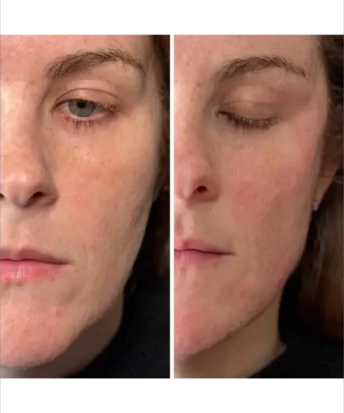 Jawline Balancing with Radiesse + Filler