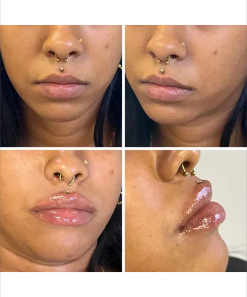 Lip Augmentation