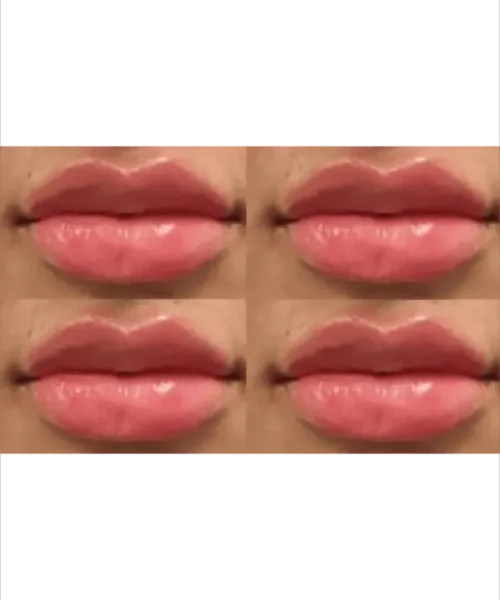 Lip Augmentation