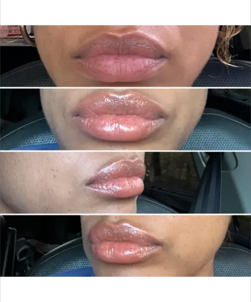 Lip Augmentation