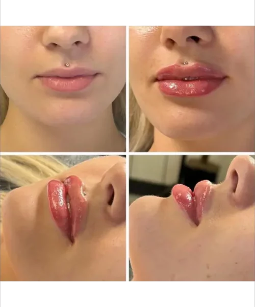 Lip Augmentation