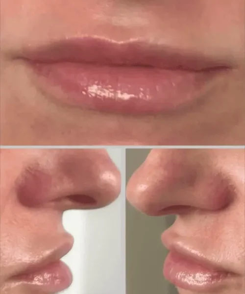 Lip Augmentation