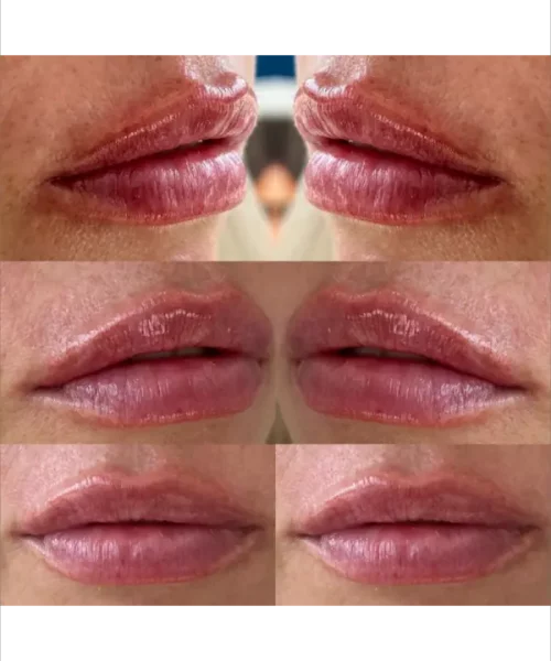 Lip Augmentation