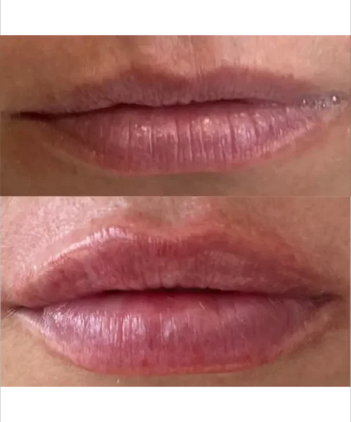 Lip Augmentation