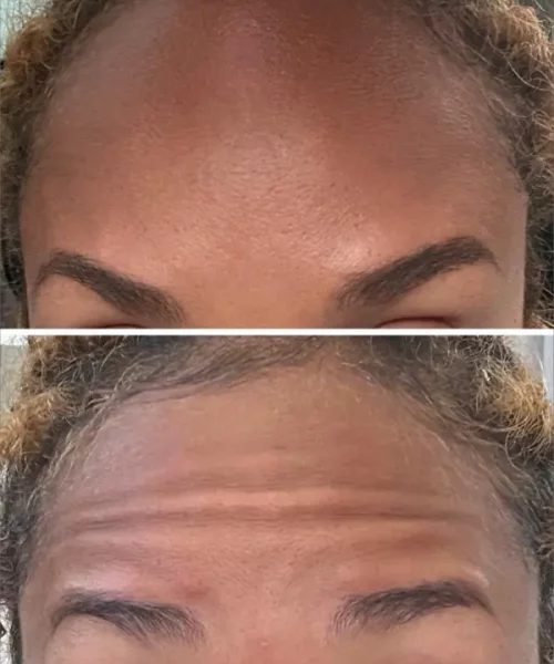 Wrinkle Relaxer with Xeomin