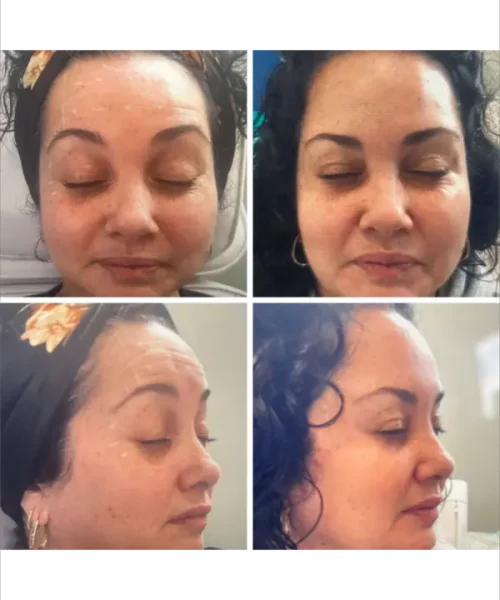 Wrinkle Relaxer with Xeomin